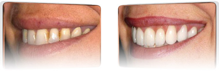 veneers photos