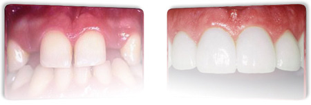 dental implants results