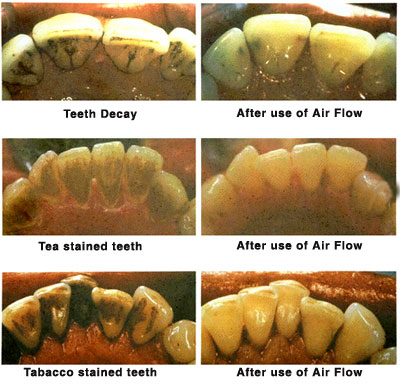 air flow dental tecnology