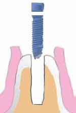 dental implant drilled hole