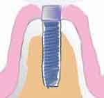 healing abutment inserted