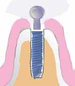 definitive abutment