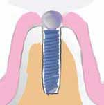 definitive abutment insertion