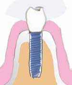 new crown on dental implant