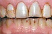 teeth needing veneers