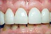 teeth with dental veneers